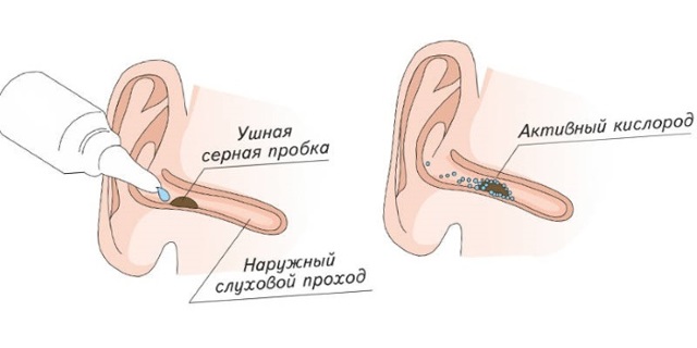 Серная пробка в ухе – лечение и удаление в домашних условиях (как почистить и пробить) 2019