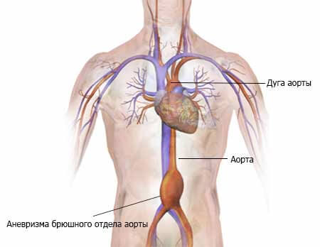 Аневризма аорты Брюшной полости: особенности заболевания и лечение