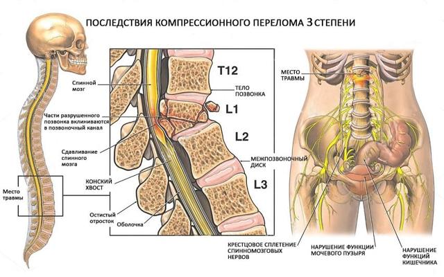 Компрессионный перелом позвоночника - лечение и реабилитация