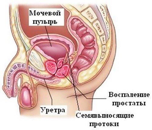 Цистит у мужчин - виды, причины, симптомы и лечение