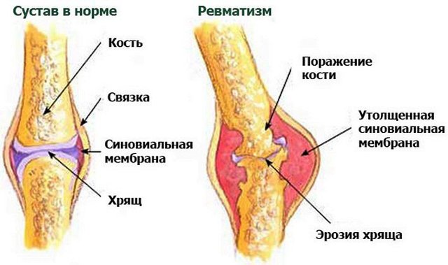 Ревматизм суставов - симптомы и лечение