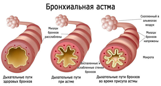 Синусит: симптомы и лечение синусита у взрослых, антибиотики — Симптомы