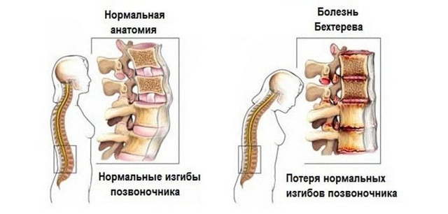 Болезнь Бехтерева – диагностика, симптомы и лечение!