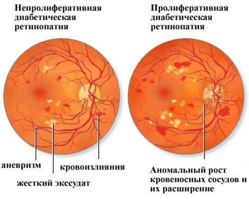 Ретинопатия - причины, признаки, симптомы и лечение
