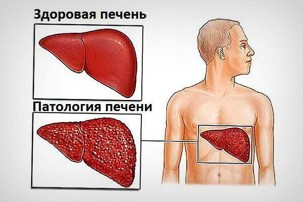 Желтые белки глаз: причины симптомы и лечение