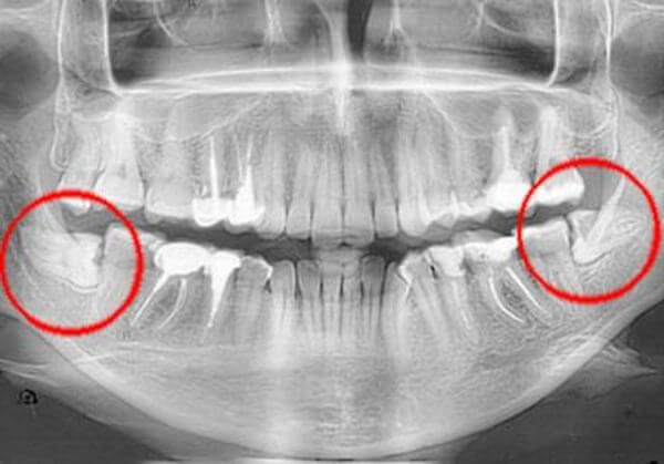 Зуб мудрости - как выглядит: описание, особенности, сроки прорезывания