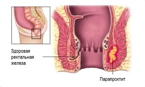 Геморрой наружный лечение и диагностика
