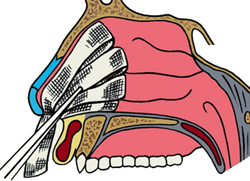 Носовое кровотечение (кровотечение из носа)