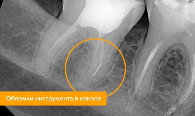 Болит зуб после удаления нерва - причины и лечение, народные средства. Как предотвратить зубную боль после удаления нерва - Автор Екатерина Данилова