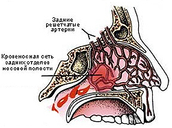 Носовое кровотечение (кровотечение из носа)
