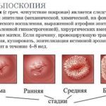 Кольпоскопия шейки матки: что это такое в гинекологии, как ее делают, подготовка к исследованию