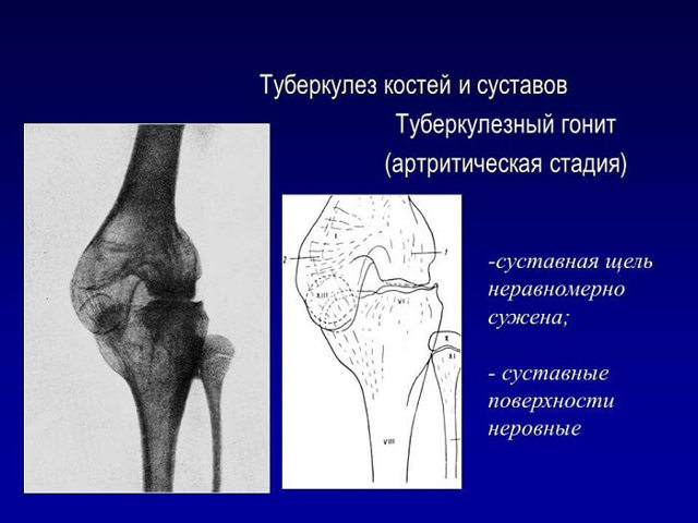 Туберкулез костей и суставов - симптомы и первые признаки