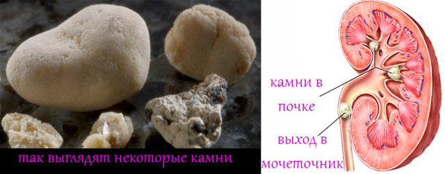 Камни в почках симптомы у женщин