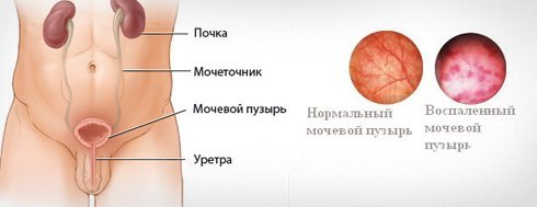 Цистит у мужчин - виды, причины, симптомы и лечение