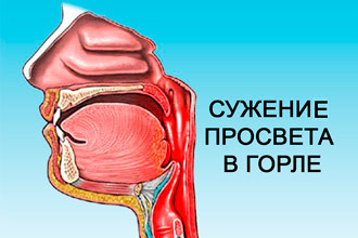 Отек горла у ребенка и взрослого - проявления, симптомы и лечение в домашних условиях