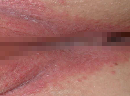 Больно писать мужчине или женщине: основные причины проблем при мочеиспускании, особенности лечения