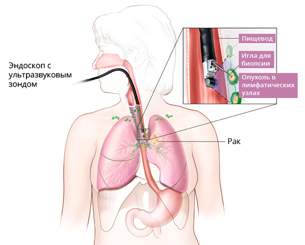 Диагностика рака легких на ранних стадиях, методы диагностики рака легких