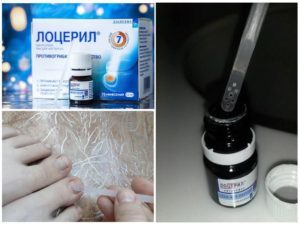 Лак Лоцерил от грибка ногтей: цена средства, отзывы