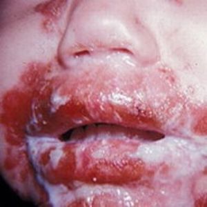 Клещевой боррелиоз - симптомы, признаки и причины болезни Лайма