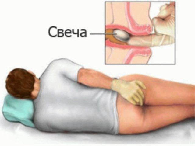 Биопрост – инструкция по применению свечей, цена, отзывы, аналоги
