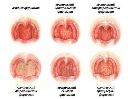 Как лечить боль в горле при глотании без температуры