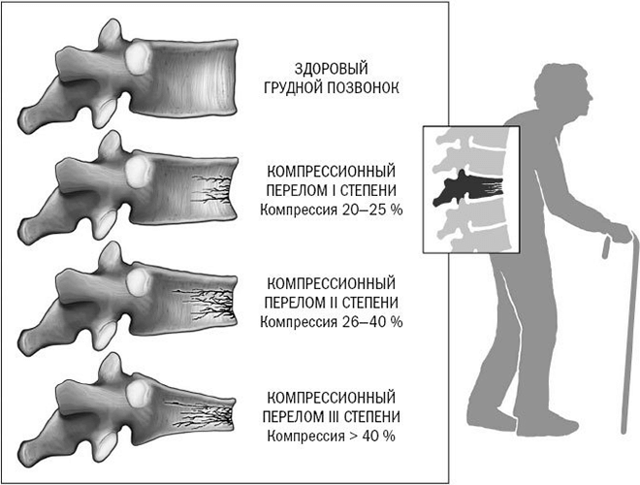 Компрессионный перелом позвоночника - лечение и реабилитация