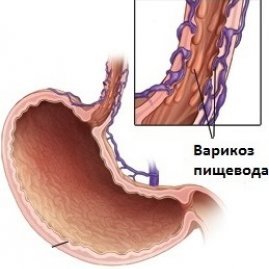 Варикозное расширение вен пищевода – особенности лечения