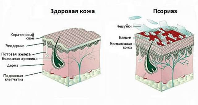 Псориатический артрит - причины, симптомы и лечение