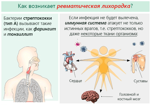 Ревматизм суставов - симптомы и лечение