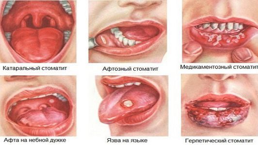 Лечение стоматита у детей – симптомы во рту, фото у грудничков