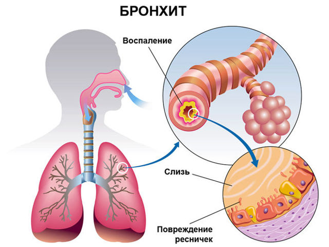Бронхит - симптомы и лечение у взрослых и детей: причины и первые признаки, как диагностировать и лечить болезнь