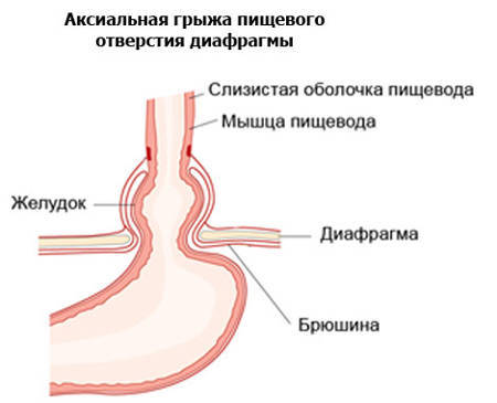Грыжа пищеводного отверстия диафрагмы (ПОД): что это такое, симптомы, лечение