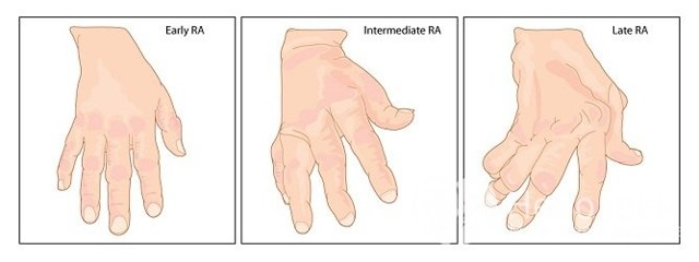 Артрит - симптомы, причины, лечение заболевания