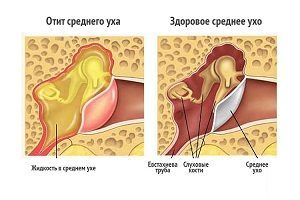 Что делать если при простуде заложило уши?