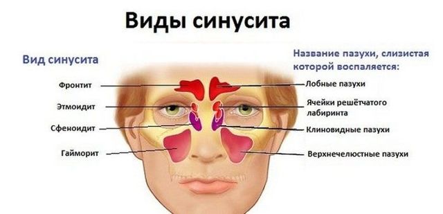 Синусит: симптомы и лечение синусита у взрослых, антибиотики — Симптомы