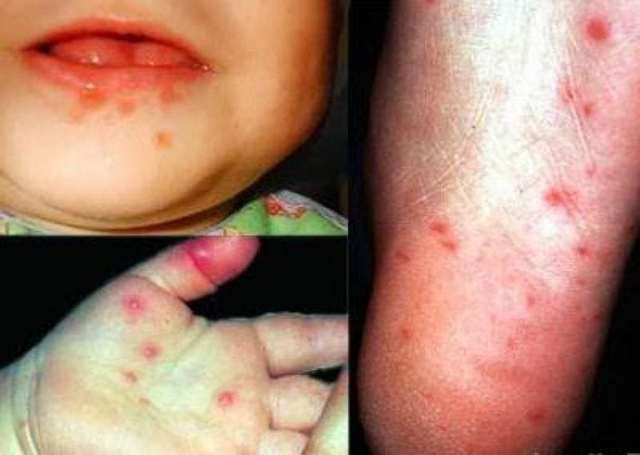Вирус Коксаки у детей: фото, симптомы и эффективное лечение