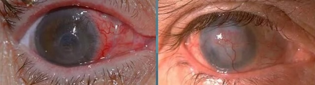 КЕРАТИТ — Большая Медицинская Энциклопедия