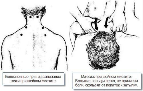 Продуло шею: как лечить в домашних условиях быстро