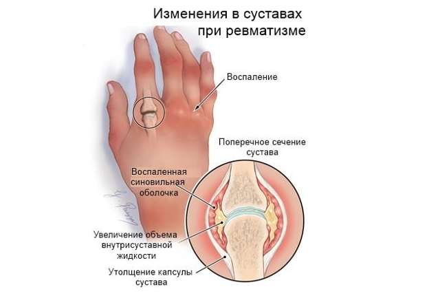 Ревматизм суставов - симптомы и лечение
