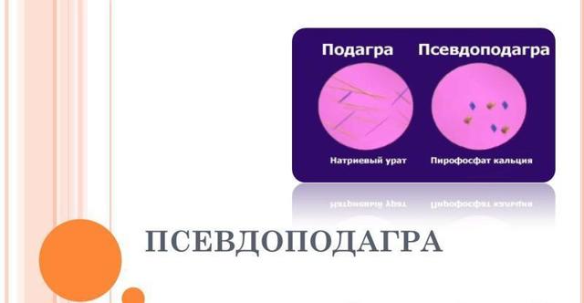 Хруст в суставах причины и лечение — Суставы