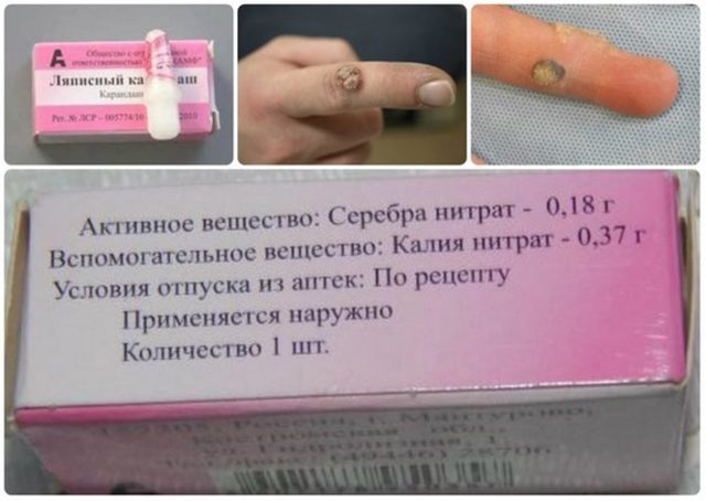 Ляписный карандаш от папиллом, инструкция по применению и отзывы