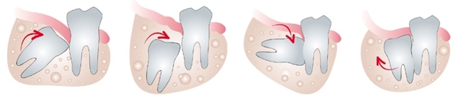 Зуб мудрости - как выглядит: описание, особенности, сроки прорезывания