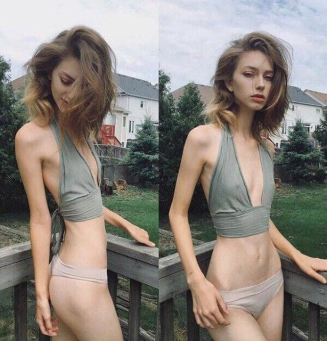 Анорексия - anorexia - ВСЁ ОБ АНОРЕКСИИ