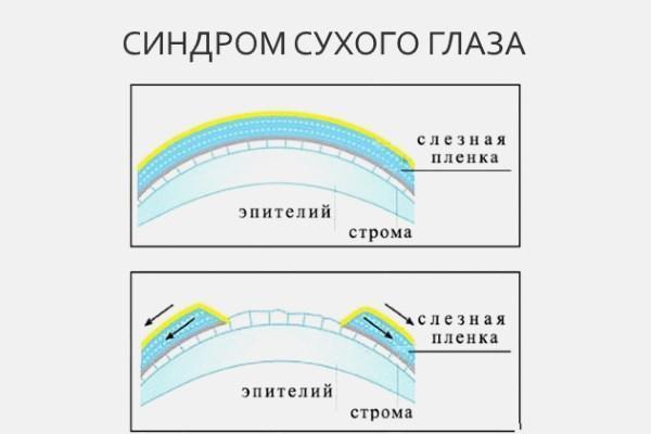 Жжение в глазах – основные причины и методы лечения