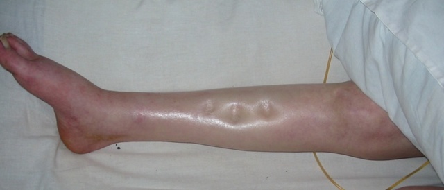 Отек ног в области стопы: причины припухлости правой и левой ступни, что делать, почему отекают ноги у женщин