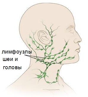 Воспаление лимфоузлов на шее - симптомы, причины и методы лечения