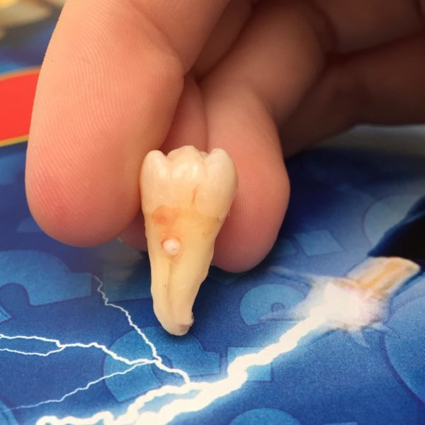 Зуб мудрости - как выглядит: описание, особенности, сроки прорезывания