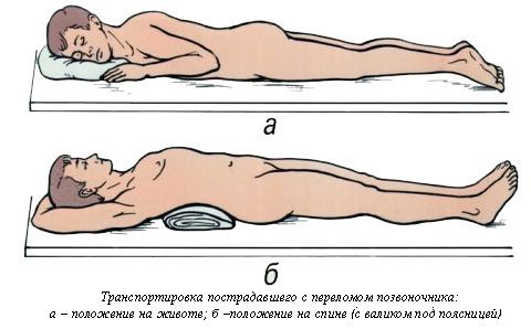 Компрессионный перелом позвоночника - лечение и реабилитация