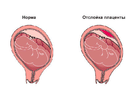 Коричневые выделения при беременности на ранних сроках