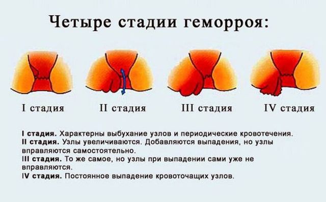 Проктозан свечи и мазь: инструкция по применению от геморроя, цена, отзывы, аналоги